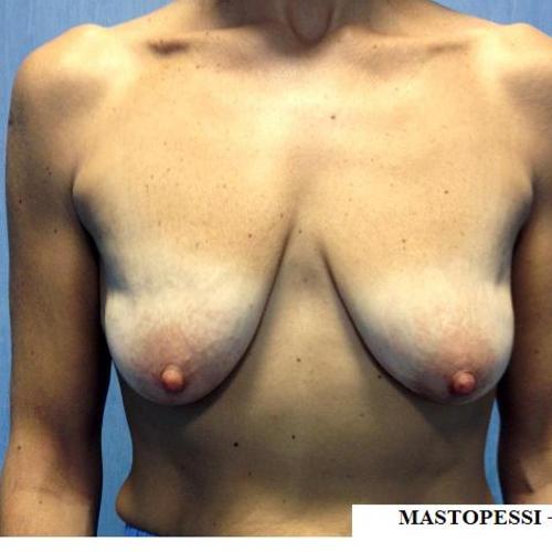 mastopessi + protesi mammarie